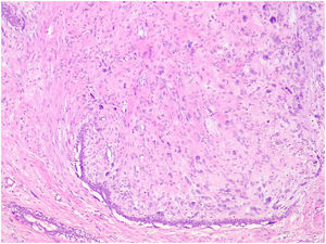 Fibroadenoma with stromal multinucleated giant cells showing some degree of atypia.