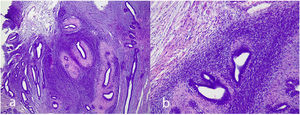 Periductal stromal tumor. Biphasic lesion without leaf-like clefts with increased stromal cell density around the epithelial tubules (a). Detail of periductal stroma without significant atypia (b).