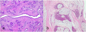 Juvenile fibroadenoma. A 4 cm lesion in a 16-year-old female patient. Fibroadenoma of pericanalicular pattern with mild increase in stromal cell density (a). A 3 cm lesion in a 22-year-old patient with focal intraductal hyperplasia in the epithelial component of the fibroadenoma (b).