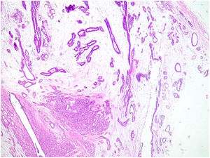 Complex fibroadenoma. Fibroadenoma with a focus of sclerosing adenosis.