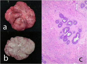 Giant fibroadenoma. Gross external aspect (a) and in its cut surface (b) of a 9 cm diameter lesion in a 14-year-old female patient. Histological findings show hyperplasia of the ductal lining epithelium (c).