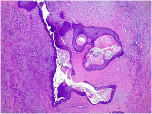 Squamous metaplasia of the lining epithelium of a cleft in a borderline phyllodes tumor.