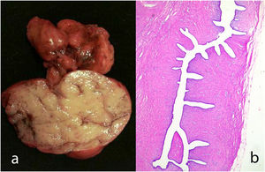 Benign phyllodes tumor. Gross appearance of a well-circumscribed lesion with presence of clefts (a). Histologically there are leaf-like clefts in a sparsely cellular stroma (b).
