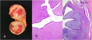Borderline phyllodes tumor. Gross appearance showing areas of hemorrhage (a). Moderate increase of stromal cellularity (b). Contour of the lesion with expansive areas and infiltrative foci (c).
