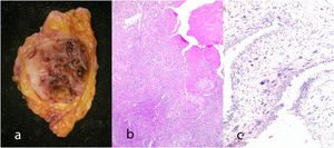 Malignant phyllodes tumor. Gross appearance of the lesion with areas of hemorrhage and necrosis (a). Accentuated increase of stromal cellularity (b). Presence of areas of myxoid aspect with pleomorphic nuclei and atypical mitosis figures (c).