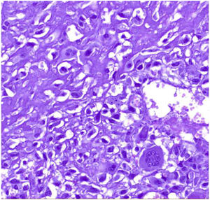 Malignant phyllodes tumor with stromal overgrowth of osteosacroma type. Malignant osteoid matrix with osteoclast and osteoblast type can be seen (courtesy of Dr. Vicente Marco, Hospital Quiron Barcelona).