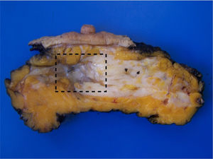 Sección de una pieza de mastectomía tras el TNA, conteniendo lecho tumoral (cuadro), con un aspecto diferente al resto del tejido, fibroso, irregular y de coloración grisácea.