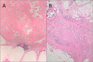 Dos ejemplos de ganglios con metástasis por carcinoma de mama al diagnóstico, y que se han negativizado tras el TNA (respuesta ganglionar completa). A) La respuesta al TNA aparece como una zona de densa esclerosis con hialinización. B) En este caso la respuesta en ganglio recuerda al lecho tumoral fibroso que aparece en la mama, con tejido fibro-desmoplásico mostrando vascularización incrementada, obliterando la arquitectura normal del ganglio (H&E, 2x).