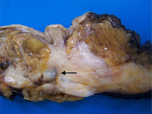 Sección de una pieza de mastectomía tras el TNA. En este caso no hay un lecho tumoral visible macroscópicamente, y la zona de asentamiento del tumor puede identificarse gracias a la identificación del marcador radiológico (flecha).