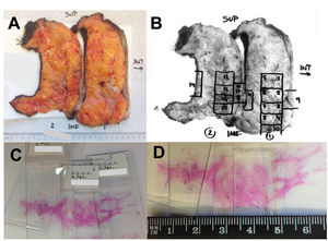 Ejemplo de muestreo de una pieza de mastectomía tras el TNA. A) Fotografía de la pieza seccionada. B) Sobre la fotografía impresa se marcan las zonas muestreadas en cada bloque. C) Preparaciones que abarcan una sección completa del tumor residual en su máxima extensión. D) Tras comprobar la presencia microscópica de tumor residual pueden determinarse sus máximos diámetros utilizando las laminillas.