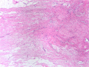 Imagen microscópica de un lecho tumoral fibroso sin celularidad neoplásica residual. Se aprecia la trama de colágena con distribución irregular, el incremento en la microvascularización y la desaparición del componente glandular normal (H&E, 4x).