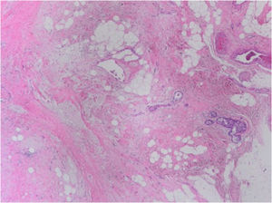 Lecho tumoral fibroso con presencia de focos residuales de carcinoma ductal in situ. Se considera como respuesta patológica completa en ausencia de componente invasivo residual en la mama y en los ganglios (H&E, 2x).