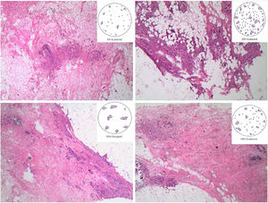 Tumor invasivo residual tras el TNA. Para establecer el porcentaje de celularidad invasiva residual, dato necesario para calcular el RCB, se hace la media de los porcentajes de afectación que encontramos en cada uno de los campos microscópicos que representan los máximos diámetros del tumor (H&E, 4x).