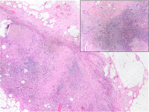 Imagen microscópica de un ganglio positivo con respuesta parcial a TNA, persistiendo nidos tumorales dispersos sobre áreas amplias de fibrosis. Para calcular el RCB se utiliza el número de ganglios afectos y el diámetro máximo de la metástasis de mayor tamaño. Este diámetro debe incluir la máxima longitud de tejido ganglionar (y de la extensión extracapsular si existe) que contenga celularidad invasiva residual, incluyendo las zonas de fibrosis interpuestas entre las áreas con nidos tumorales (H&E, 2x con ampliación 10x en el recuadro).