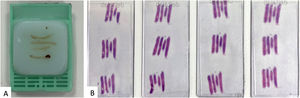 Four cores are included in the same tissue block with four levels of cutting. Additional studies such as immunohistochemistry, will be performed on the whole sample. If needed, the cores could be subsequentially separated.