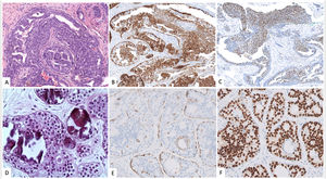 A,B,C Usual ductal hyperplasia. Messy proliferation of cells with heterogeneous expression of CK5/6 (B) and ER (C). D,E y F Atypical Ductal Hyperplasia. Homogeneous proliferation of luminal epithelial cells which lack expression of CK5/6 and intense and homogeneous expression of ER (E).