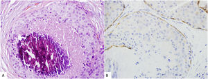 A. Pleomorphic lobular carcinoma. Discohesive high-grade cell proliferation with comedonecrosis and microcalcification. B. E-cadherin expression is lost.