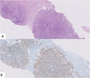 A. Lobulocentric architecture of a sclerotic lesion. B. Calponina stain marks myoepithelial cells.