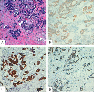 A. Metastatic colonic carcinoma to breast. B. Tumoral cells are negative for GATA 3, showing no nuclear but membranous staining. C–D. Intense positive stain for CK20 and CDX2 confirmin colonic origin.