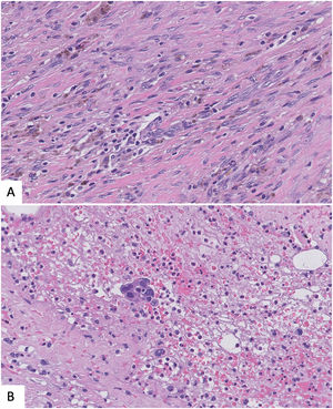 A. Fibrosis, hemorrage, hemosiderin deposits secondary to CNB. B. Epithelial displaced into the biopsy tract. Note the lack of demoplasia.
