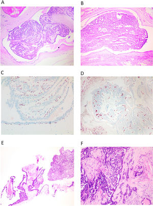 A y B) Imagen de PI, en hematoxilina eosina, correspondiente a una biopsia dirigida donde se puede ver la lesión completa dentro de un ducto dilatado (x100, H-E). C) Se observa la hilera completa de CME bajo el epitelio que reviste el ducto y en los tallos de las papilas, con inmunohistoquímica para p63 (x200). D) Con una tinción inmunohistoquímica para CD34, observamos los tallos vasculares en todas las papilas (x100). E) En una BAG, se entremezclan los fragmentos del ducto que aloja el PI, con los propios fragmentos papilares (x100, H-E). F) Si se produce fibrosis por isquemia en el PI, quedan atrapadas estructuras epiteliales, que simulan invasión (x100, H-E).