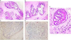 A y B) Imagen de carcinoma papilar in situ ocupando varios ductos (x100, H-E). C) Se observa un revestimiento de CME en el ducto, con ausencia de trama de CME en las papilas (x200, IHQ p63). D) Se ponen de manifiesto las papilas por el eje vascular, que marca con CD34 (x200, IHQ CD34). E) En esta imagen se observa un CPIS rodeado por un carcinoma infiltrante de mama (x200, H-E).