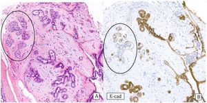 Fibroadenoma with atypical lobular hyperplasia (ALH). A) Hematoxylin–Eosin: lobular proliferation in fibroepithelial lesion. B) E-cadherin: loss of expression in areas with ALH (E-cad).
