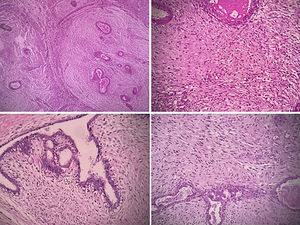 Neoplasia fibroepitelial con celularidad estromal moderada, atipia nuclear leve a moderada y escasas figuras mitóticas. El componente epitelial presenta estructuras tubulares dilatadas y elongadas tapizadas por células ductales y mioepiteliales sin atipia (HE 4x y 10x).