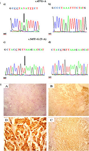I. a. Partial chromatograms of PTEN mutations: a and c, mutations (457G>A and 545T>G (T>A)) of exon 5 and 6 respectively; b and d, wild-type sequences. Arrows, position of the mutations. II. Representative of immunohistochemical staining (brown stain) of PTEN protein level in HER-2 positive breast carcinoma. PTEN level was scored as (A) -, no cytoplasmic staining (×100); (B) +1, weak staining (×100); (C) +2, moderate staining (×100); and (D) +3, strong staining (×400).