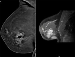 Mujer de 77 años. Comparativa entre el estudio de mamografía con contraste e imagen de sustracción del estudio dinámico de resonancia magnética donde se objetiva una extensión del tumor superponible con ambas técnicas. El resultado anatomopatológico fue carcinoma ductal infiltrante.