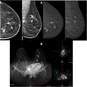 Mujer de 37 años con múltiples nódulos hipercaptantes. A) Afectación a la práctica totalidad del cuadrante súpero-interno de la mama izquierda, en estudio de mamografía convencional (izquierda) y en estudio de mamografía con contraste (derecha). B) Área total aproximada de 9,7 x 4,5 x 8 cm, que se correlaciona correctamente con la imagen de resonancia. Se realizó biopsia con aguja gruesa de 2 nódulos con resultado de carcinoma ductal infiltrante.