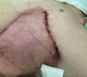Mastectomía e injerto cutáneo.