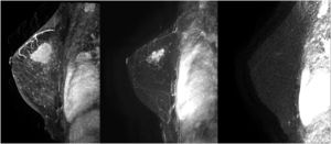 Dynamic study MRI. A: Pretreatment. B: Intermediate. C: End of treatment.
