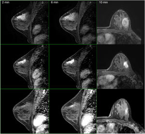 Late enhancement study MRI.
