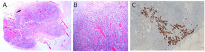 A) Ganglio linfático con infiltración tumoral (flecha), (H&E 40x). B) Detalle de la infiltración tumoral en forma de células sueltas (H&E 200x). C) Expresión de citoqueratina 19 (100x).