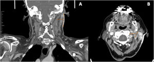 A y B) Imagen coronal y axial de tomografía computarizada cérvico-torácico: engrosamiento cutáneo retroauricular y adenopatías cervicales (flecha).