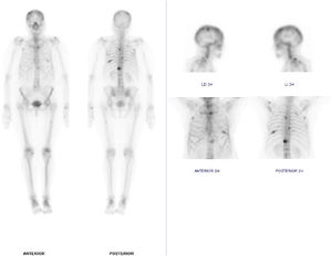 Gammagrafía, anterior y posterior: enfermedad ósea metastásica diseminada (lesiones osteoblásticas): calota parietal derecha y frontal, manubrio esternal, escápula izquierda, en vertiente izquierda de D5, derecha de D8 e izquierda de D12, 4ª costilla derecha, 8ª costilla izquierda, 9ª costilla bilateral y en tercio medio de diáfisis femoral izquierda.