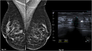 Mamografía y ecografía mamaria. A) Mamografía bilateral en proyección oblicua medio lateral que muestra un nódulo denso, con margen espiculado, en el plano posterior del cuadrante inferoexterno de la mama derecha (flecha blanca). B) Ecografía de cuadrante inferoexterno de la mama derecha que muestra un nódulo hipoecogénico, irregular, con margen indefinido, de 13 x 9,6 mm, con orientación antiparalela y sombra acústica posterior.