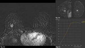 Resonancia magnética de mama, estudio dinámico EG 3D tras la administración de gadolinio. A) Plano axial de ambas mamas. B) Plano sagital y coronal de la mama derecha, que muestran un nódulo con margen irregular y realce heterogéneo. C) Curva dinámica con crecimiento progresivo y posterior meseta (curva tipo ii).