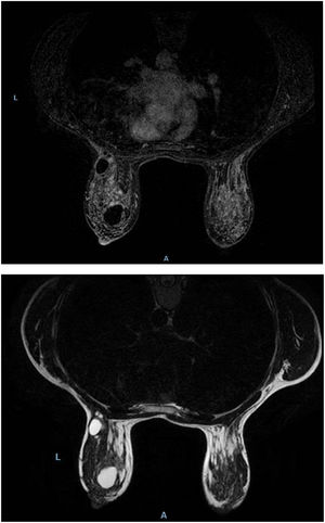 Resonancia magnética de mamas en secuencias T1 y T2, respectivamente. Se identifican en la mama izquierda imágenes nodulares, ovaladas y bien delimitadas, de contornos lisos y lobulados, que presentan intensidad de señal homogénea, hipointensas en T1 e hiperintensas en T2, compatible con lesiones quísticas.