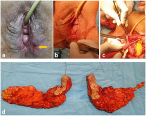 (a) Bilateral vulvar lesions with left ulceration (yellow arrow). (b) Incision drawing. (c) Subcutaneous dissection of the left vulva. (d) Bilateral vulvectomy specimen oriented by two wires. (For interpretation of the references to color in this fig. legend, the reader is referred to the web version of this article.)