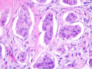 Carcinoma micropapilar infiltrante: detalles de células tumorales con núcleos con escaso pleomorfismo nuclear y citoplasma ligeramente eosinófilo (HE x 400).