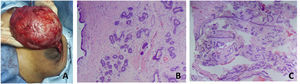 A) Hallazgos intraoperatorios de la lesión. B) y C) Microfotografía de corte histológico coloreado con hematoxilina y eosina, observándose la neoplasia fibroepitelial mencionada, tratándose de una proliferación de conductos galactofóricos, unos estrechos y otros ramificados, revestidos por un epitelio biestratificado regular sin atipias, bajo un estroma fibroconectivo laxo, sin evidencia de mitosis ni necrosis.