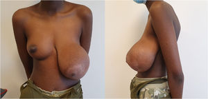 Breast asymmetry.