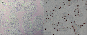 Photomicrograph of histopathology, stained with HE (A) and immunohistochemistry for p63 (B).