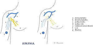 Dibujo esquemático de la técnica LYMPHA (con el permiso de F. Boccardo y John Wiley and Sons39).