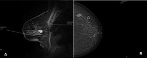 A) Resonancia magnética de mama izquierda, con realce heterogéneo del nódulo localizado en tercio medio profundo. B) Mamografía: nódulo hiperdenso espiculado en el cuadrante superior externo de la mama izquierda.