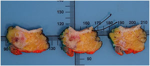Cortes macroscópicos donde se visualiza la lesión.