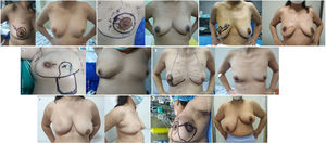 A) Mamoplastia lateral. B) Mamoplastia circular o round block. C) Mamoplastia transversal o batwing. D) Mamoplastia surco submamario. E) Mamoplastia vertical rama única F) Mamoplastia Grissoti. G) Mamoplastia vertical de rama doble.