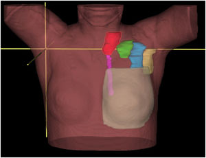 Niveles ganglionares, axilar I (amarillo), axilar II (azul), axilar III (verde), axilar IV o supraclavicular (rojo) y mamaria interna (rosa). En gris está representado el volumen mamario.